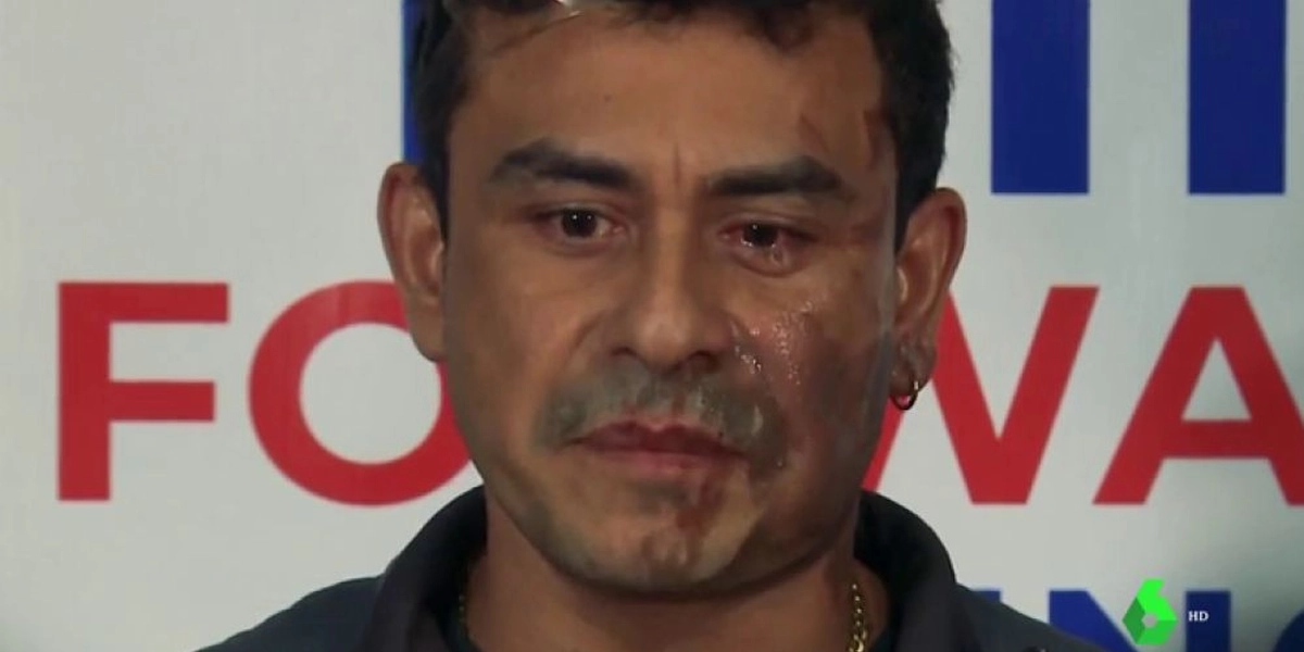 Ciudadano americano es atacado con ácido en la cara y le gritan “Que regrese a su país”